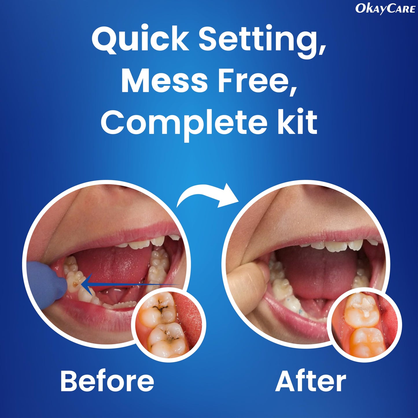 Zinc Oxide Eugenol Dental Cement Kit – Instant Tooth Repair, Cap, Crown & Bridge Filling | Ultra Strong & Pulp-Soothing Formula | Long Lasting - Easy Mix-and-Use Dental Adhesive for DIY, Home & Clinic